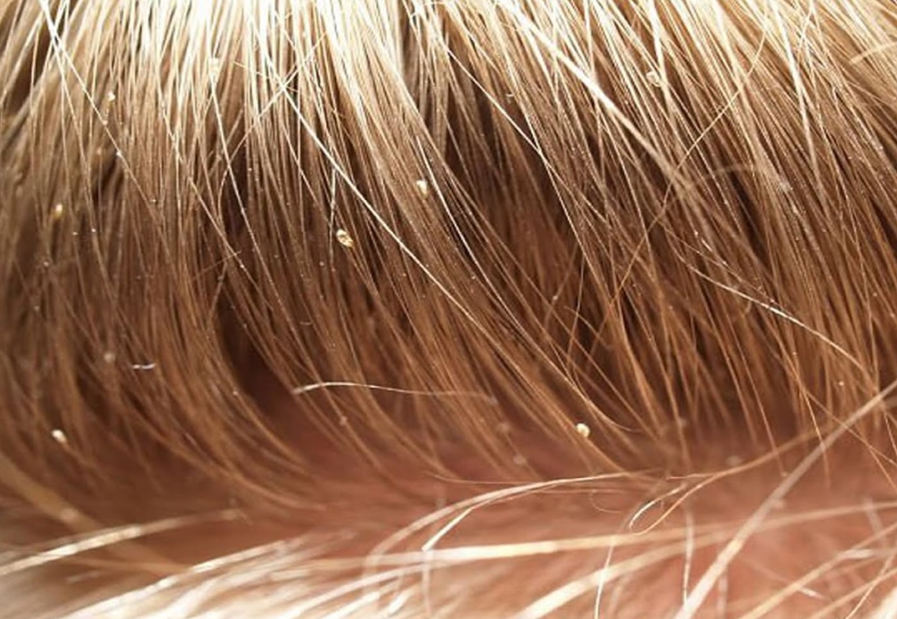 Lestad ei vaeva teid enam: tõestatud meetod teepuuõliga